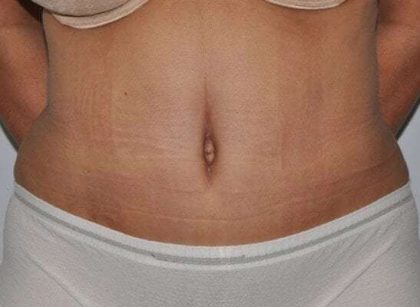 Abdominoplasty (Tummy Tuck) Before & After Patient #928