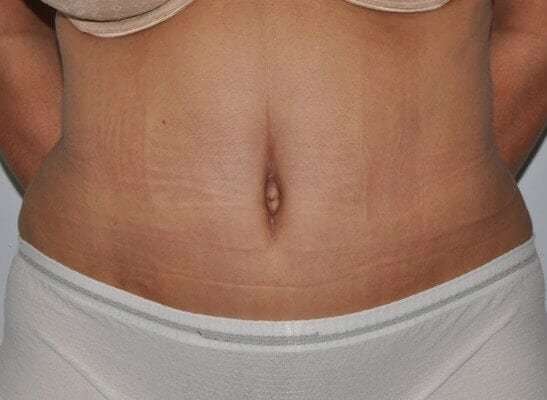 Abdominoplasty (Tummy Tuck) Before & After Patient #928