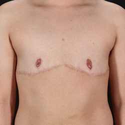 Female To Male Breast Before & After Patient #4119