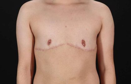 Female To Male Breast Before & After Patient #4119