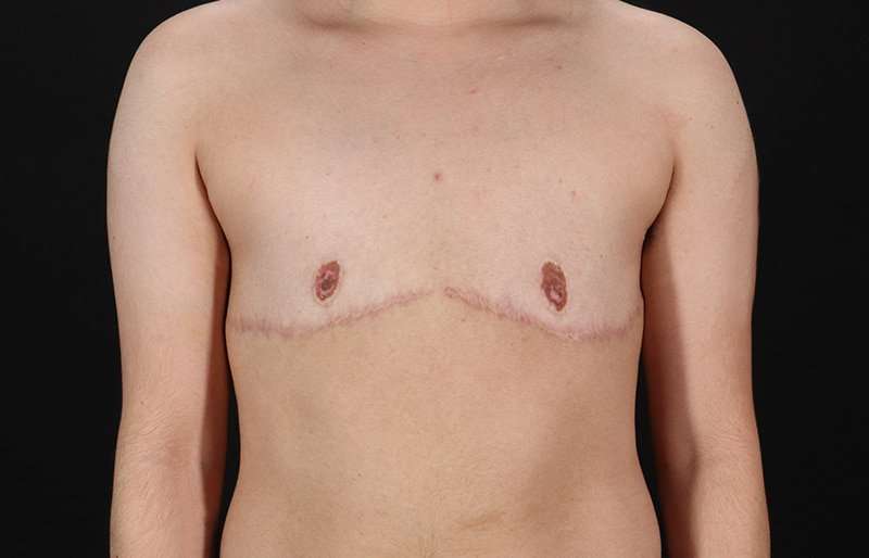 Female To Male Breast Before & After Patient #4119