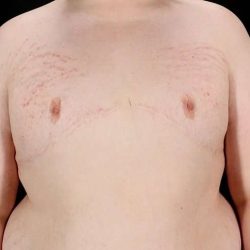 Female To Male Breast Before & After Patient #4130