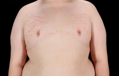 Female To Male Breast Before & After Patient #4130