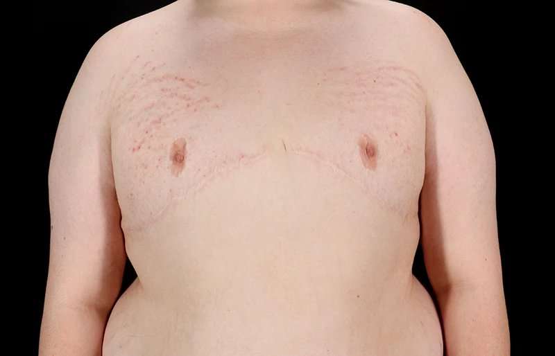 Female To Male Breast Before & After Patient #4130