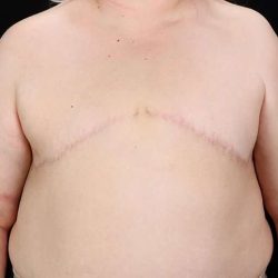 Female To Male Breast Before & After Patient #4141