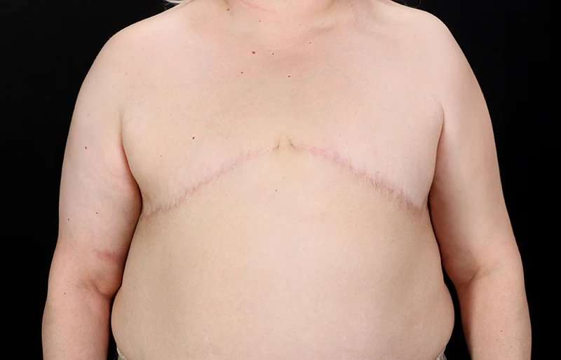 Female To Male Breast Before & After Patient #4141
