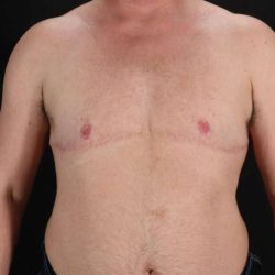 Female To Male Breast Before & After Patient #4152