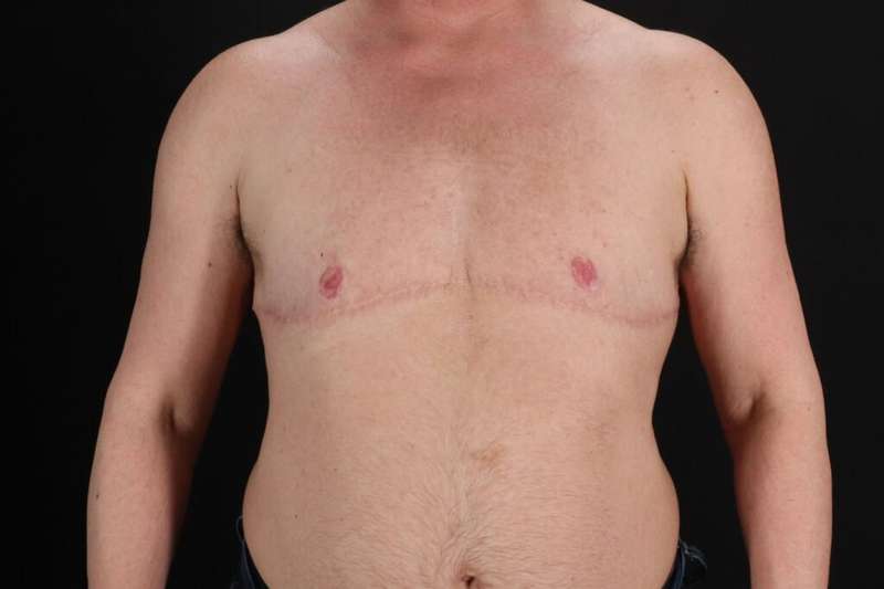 Female To Male Breast Before & After Patient #4152