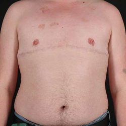 Female To Male Breast Before & After Patient #4163