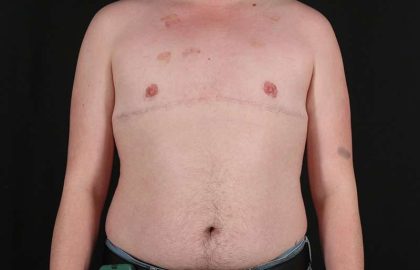 Female To Male Breast Before & After Patient #4163