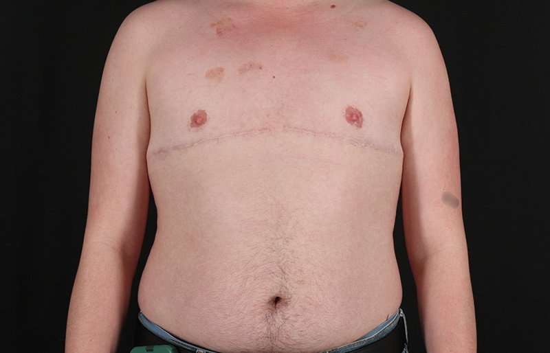 Female To Male Breast Before & After Patient #4163