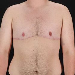 Female To Male Breast Before & After Patient #4174