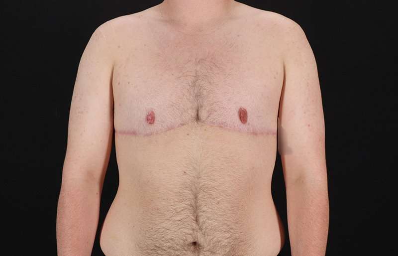 Female To Male Breast Before & After Patient #4174