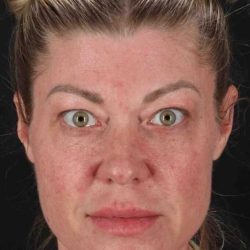 Fat Grafting To The Face Before & After Patient #4232