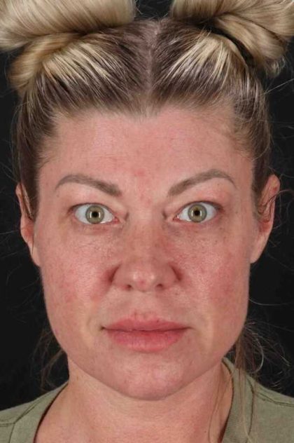 Fat Grafting To The Face Before & After Patient #4232