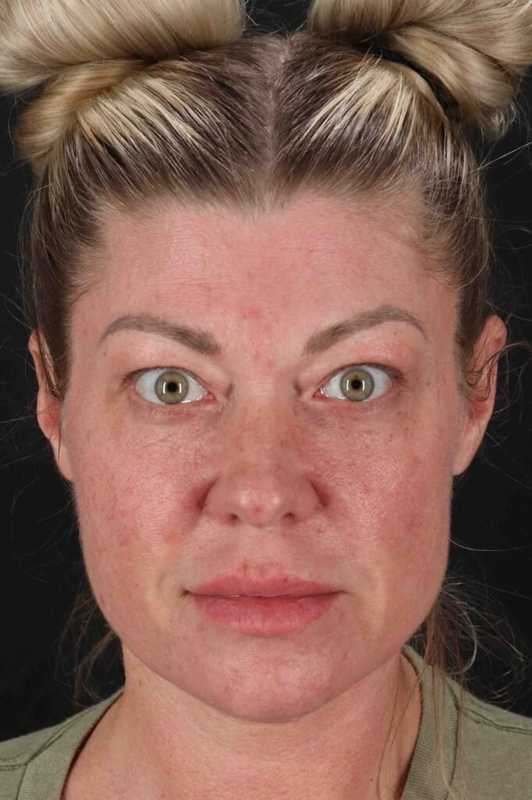 Fat Grafting To The Face Before & After Patient #4232