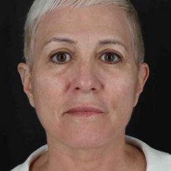 Fat Grafting To The Face Before & After Patient #4294
