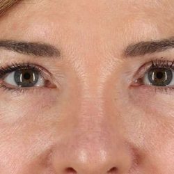 Blepharoplasty (Eyelid Surgery) Before & After Patient #4316