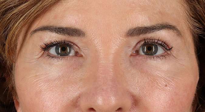 Blepharoplasty (Eyelid Surgery) Before & After Patient #4316