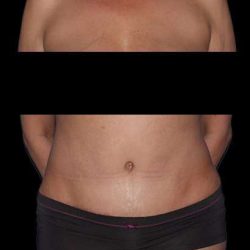 Abdominoplasty (Tummy Tuck) Before & After Patient #590