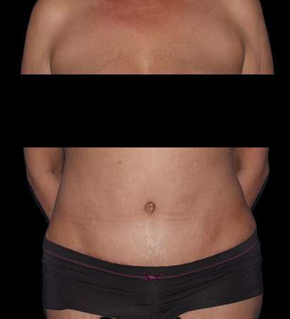 Abdominoplasty (Tummy Tuck) Before & After Patient #590