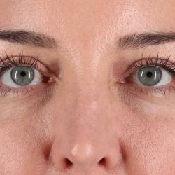 Blepharoplasty (Eyelid Surgery) Before & After Patient #4338