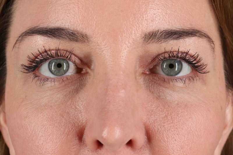 Blepharoplasty (Eyelid Surgery) Before & After Patient #4338