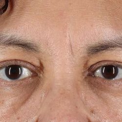 Blepharoplasty (Eyelid Surgery) Before & After Patient #4349
