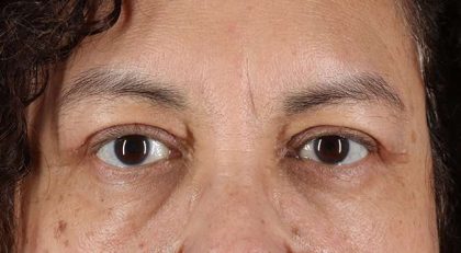 Blepharoplasty (Eyelid Surgery) Before & After Patient #4349