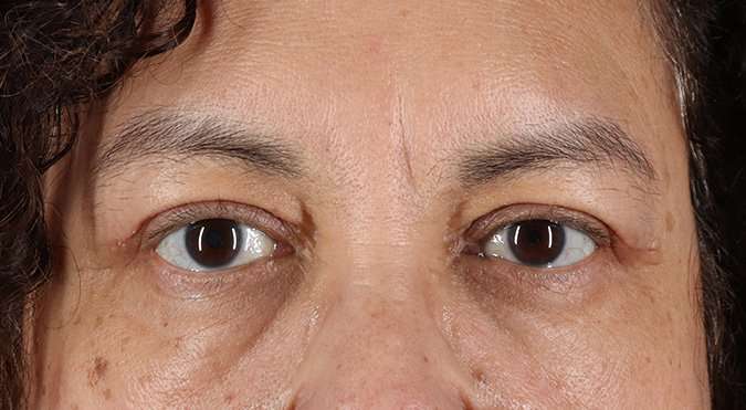 Blepharoplasty (Eyelid Surgery) Before & After Patient #4349