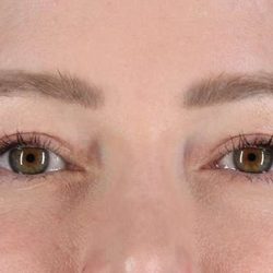 Blepharoplasty (Eyelid Surgery) Before & After Patient #4360