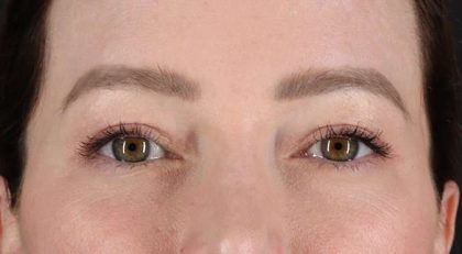 Blepharoplasty (Eyelid Surgery) Before & After Patient #4360