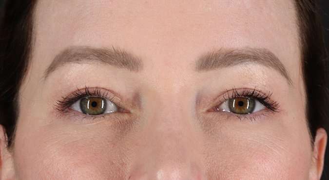 Blepharoplasty (Eyelid Surgery) Before & After Patient #4360