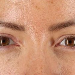 Blepharoplasty (Eyelid Surgery) Before & After Patient #4371