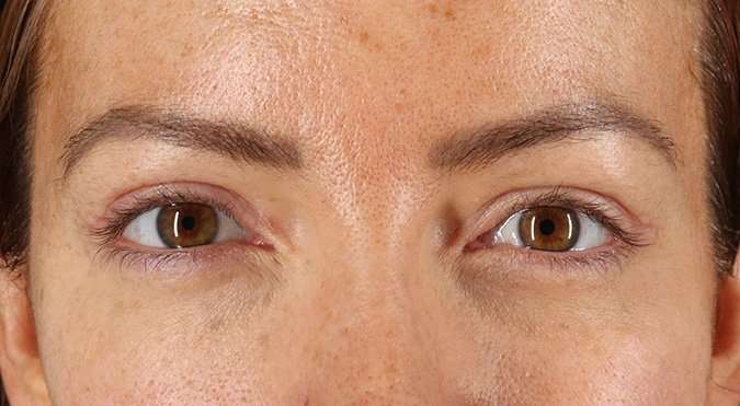 Blepharoplasty (Eyelid Surgery) Before & After Patient #4371