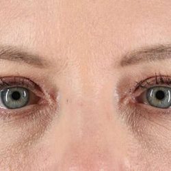 Blepharoplasty (Eyelid Surgery) Before & After Patient #4382