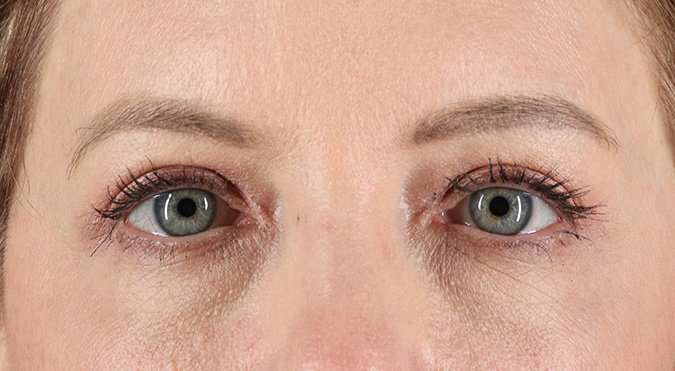 Blepharoplasty (Eyelid Surgery) Before & After Patient #4382
