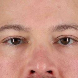 Blepharoplasty (Eyelid Surgery) Before & After Patient #4393