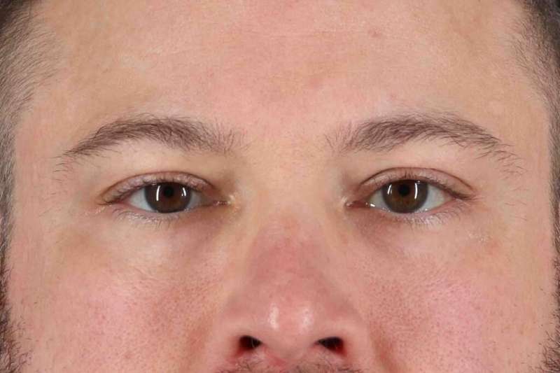 Blepharoplasty (Eyelid Surgery) Before & After Patient #4393