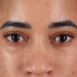 Blepharoplasty (Eyelid Surgery) Before & After Patient #4404