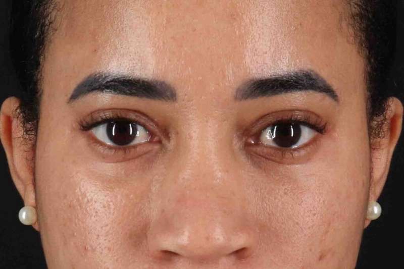 Blepharoplasty (Eyelid Surgery) Before & After Patient #4404
