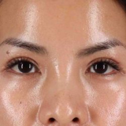 Blepharoplasty (Eyelid Surgery) Before & After Patient #4415