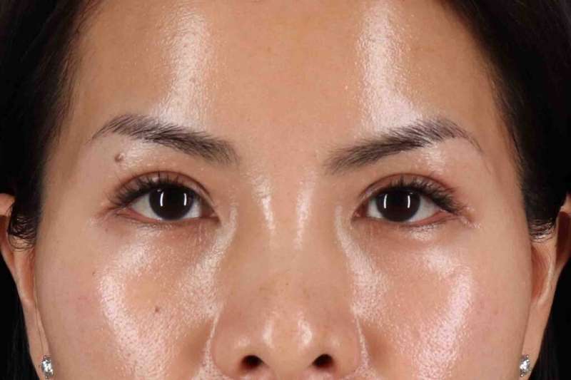 Blepharoplasty (Eyelid Surgery) Before & After Patient #4415