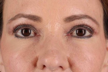 Blepharoplasty (Eyelid Surgery) Before & After Patient #4426