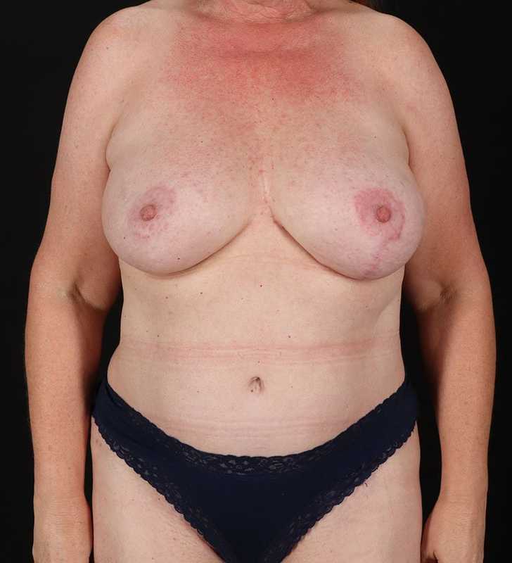 Abdominoplasty (Tummy Tuck) Before & After Patient #962