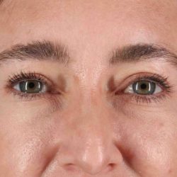 Blepharoplasty (Eyelid Surgery) Before & After Patient #4437