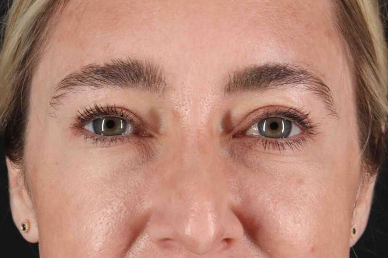 Blepharoplasty (Eyelid Surgery) Before & After Patient #4437