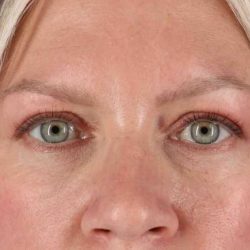 Blepharoplasty (Eyelid Surgery) Before & After Patient #4448