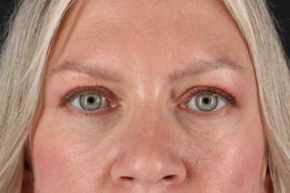 Blepharoplasty (Eyelid Surgery) Before & After Patient #4448