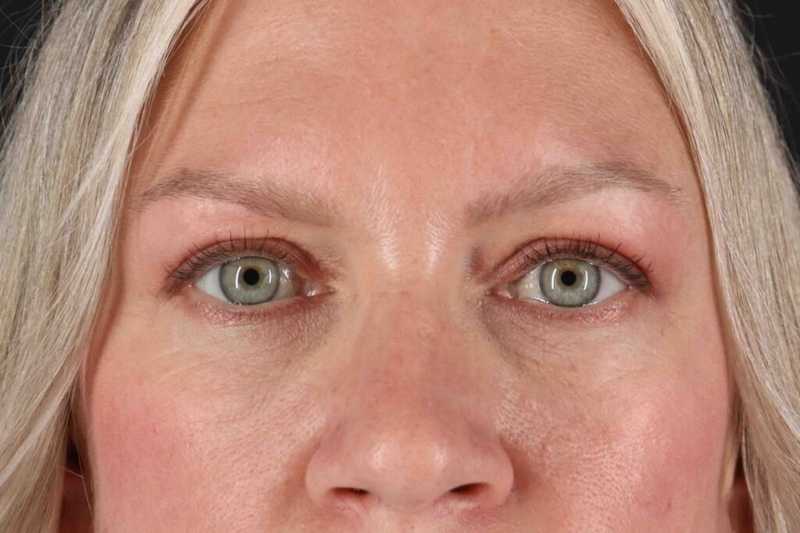 Blepharoplasty (Eyelid Surgery) Before & After Patient #4448